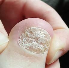 灰指甲人与人之间传染吗